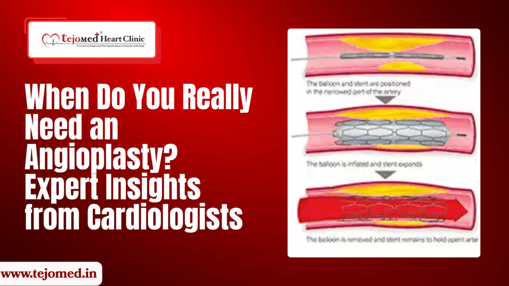 When Do You Really Need an Angioplasty? Expert Insights from Cardiologists