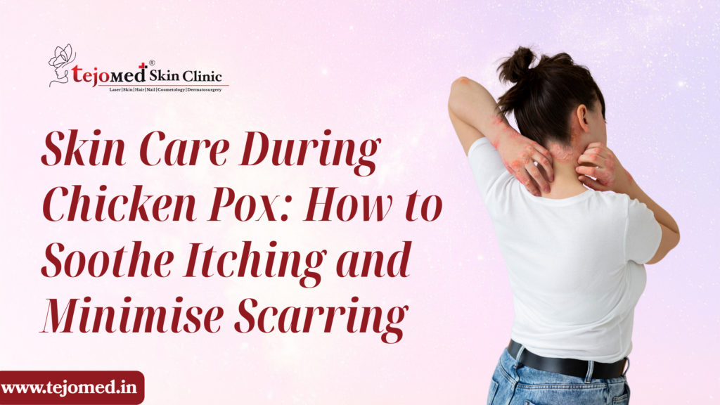 Skin Care During Chicken Pox: How to Soothe Itching and Minimise Scarring