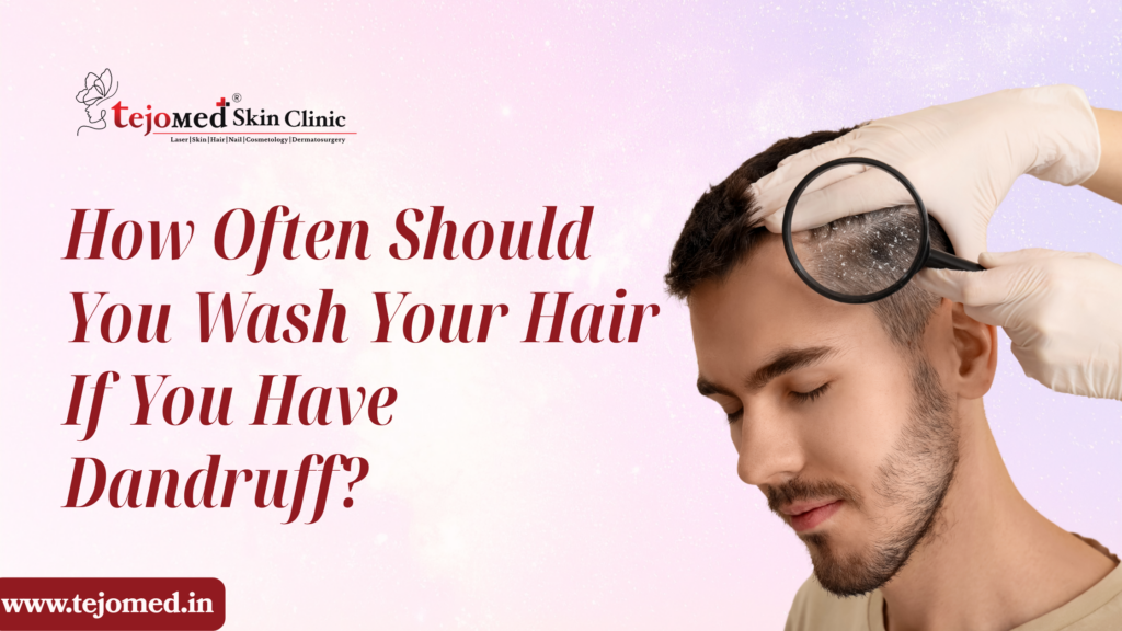 How Often Should You Wash Your Hair If You Have Dandruff?