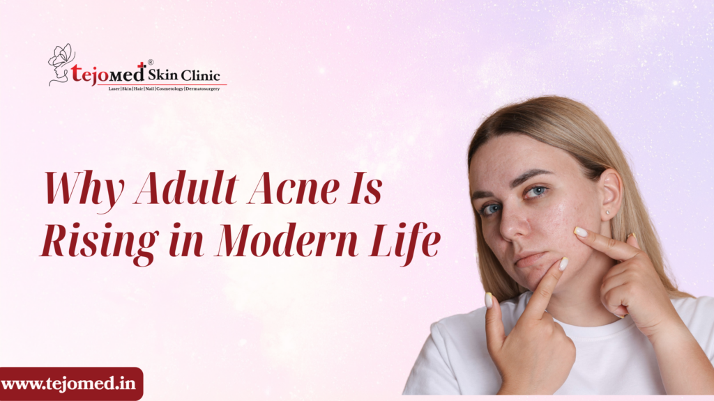 Why Adult Acne Is Rising in Modern Life