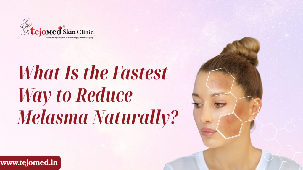 What Is the Fastest Way to Reduce Melasma Naturally?