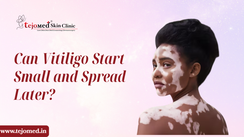 Can Vitiligo Start Small and Spread Later?