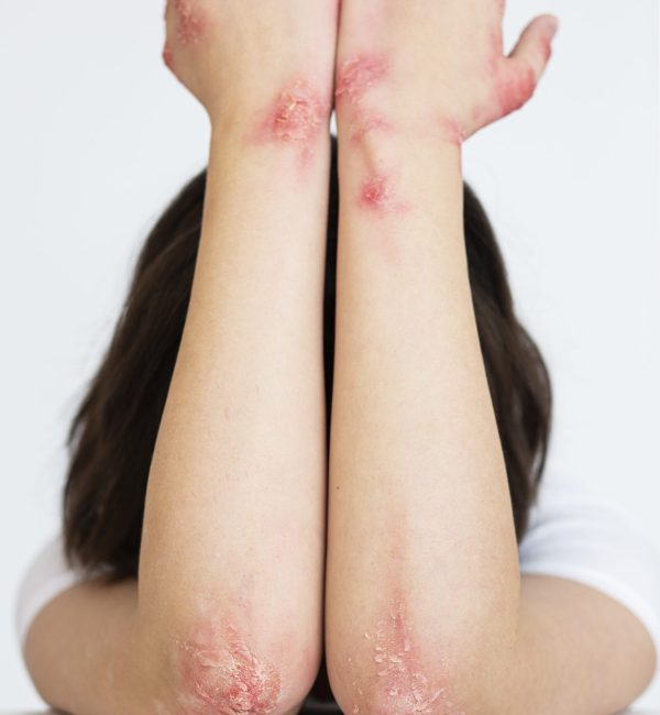 hands-patient-suffering-from-psoriasis (2)