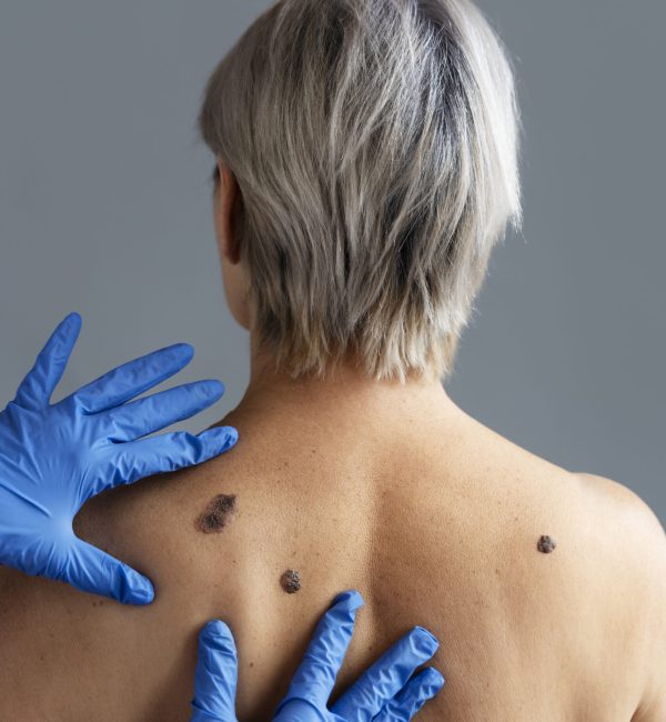 hands-with-gloves-touching-skin-with-melanoma