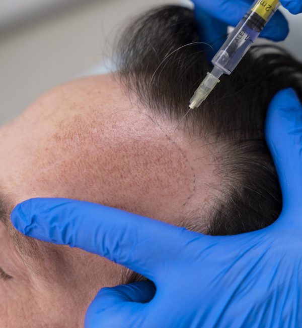 Hair Transplant Treatment in Baner