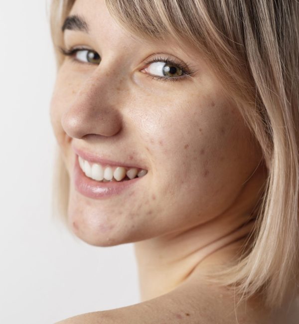 Acne Scar Treatment in Baner